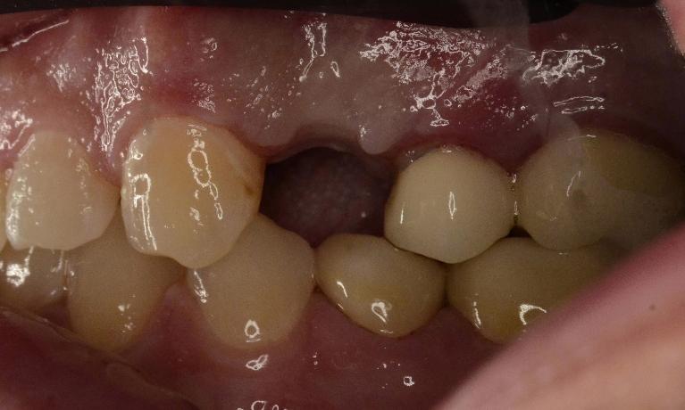 patient missing tooth in smile zone