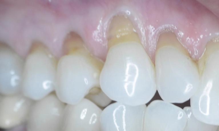 Discolored teeth with exposed roots