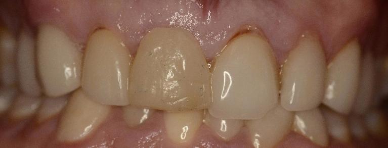 Broken Veneers | Alpharetta Creek Restorative Dentistry