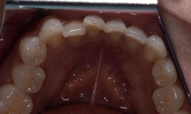 clear aligner before photos