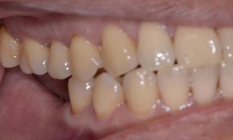 implant and crown used to fix a broken tooth